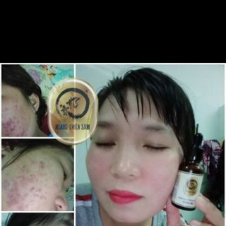 Tinh Chất Tái Tạo Trị Mụn Nám Sẹo Rỗ