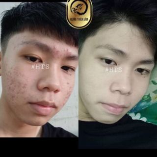 Tinh Chất Tái Tạo Trị Mụn Nám Sẹo Rỗ