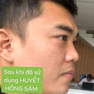 Trước và sau khi sử dụng Huyết Hồng Sâm