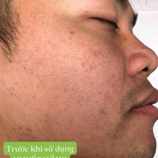 Trước và sau khi sử dụng Huyết Hồng Sâm