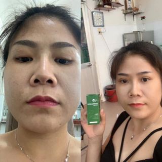 HERBAL ACNE SERUM CHAI BAN ĐÊM