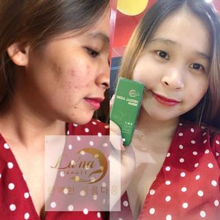 HERBAL ACNE SERUM CHAI BAN ĐÊM