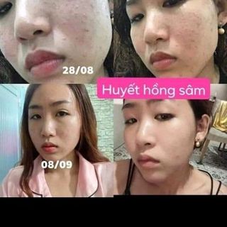 Trước và sau khi sử dụng Huyết Hồng Sâm