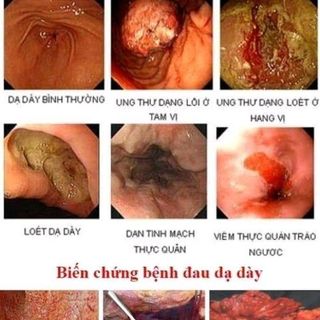 thốc dạ dầy duọc liệu diệu phương