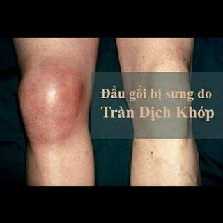 THUỐC XOA BÓP GIA TRUYỀN DƯỢC LIỆU DIỆU PHƯƠNG