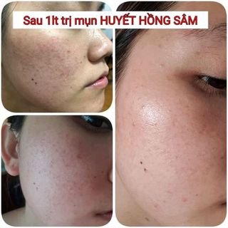 Da đẹp sau 1 liệu trình Huyết Hồng Sâm giá sỉ