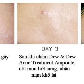 Tinh Chất Đặc Trị Mụn Dưỡng Da Dew Dew Acne Treatment Ampoule 30ml