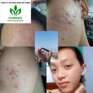 gia công cao lá nam trị mụn