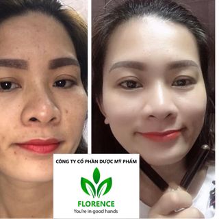 gia công cao lá nam trị mụn