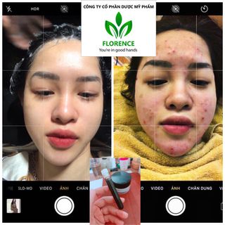 gia công cao lá nam trị mụn