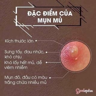 Kem trị mụn-nám hoa đào