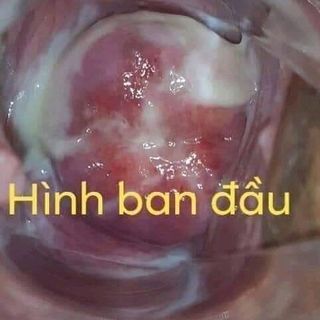 Cách đặt viên đặt Phụ khoa Nữ Oa