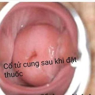viên đặt trinh nữ
