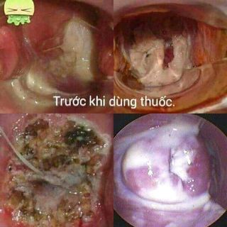 viên đặt trinh nữ