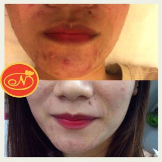 DƯỠNG CHẤT HỖ TRỢ ĐẨY LÙI MỤN NUTRIENT REPEL ACNE BẢN CẢI TIẾN - SẢN PHẨM HỖ TRỢ CHO DỊCH VỤ SPA