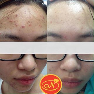 DƯỠNG CHẤT HỖ TRỢ ĐẨY LÙI MỤN NUTRIENT REPEL ACNE BẢN CẢI TIẾN - SẢN PHẨM HỖ TRỢ CHO DỊCH VỤ SPA