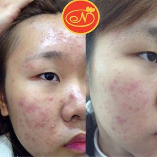 DƯỠNG CHẤT HỖ TRỢ ĐẨY LÙI MỤN NUTRIENT REPEL ACNE BẢN CẢI TIẾN