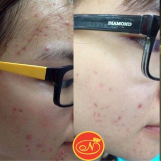 DƯỠNG CHẤT HỖ TRỢ ĐẨY LÙI MỤN NUTRIENT REPEL ACNE BẢN CẢI TIẾN