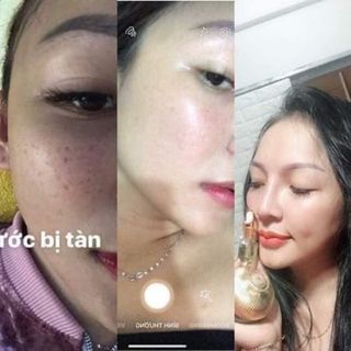 Kem đặt trị nám tàn nhang đồi mồi giá sỉ