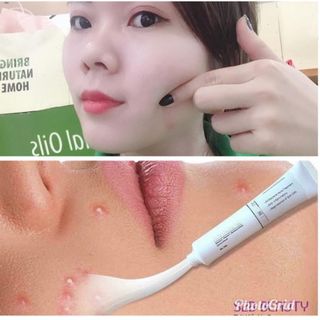 ĐẶC TRỊ MỤN S2B