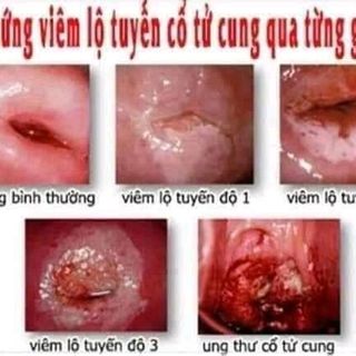 viêm lộ tuyến cổ tử cung con đường ngắn nhất dẫn đến ung thư cổ tử cung