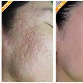 Thuốc đông y trị sẹo rỗ Genie non fix skin Hàn Quốc