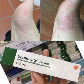 Thuốc trị vảy nến á sừng Demovate Cream Thái Lan