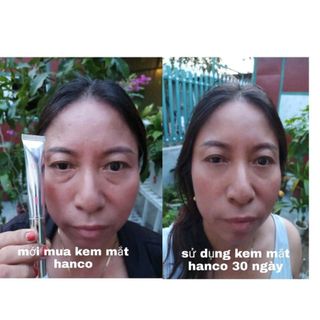 kem trị thâm mắt hanco việt nam
