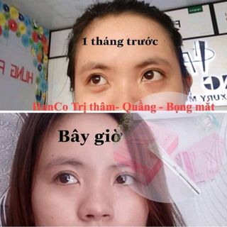 kem trị thâm mắt hanco việt nam