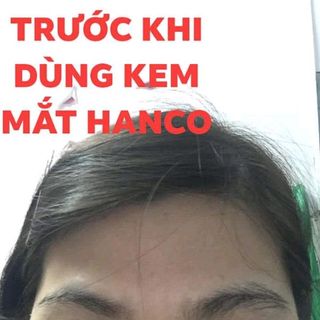 kem trị thâm mắt hanco