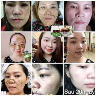 cao trị nám tàn nhang lâu năm cty SẮC MỘC LAM