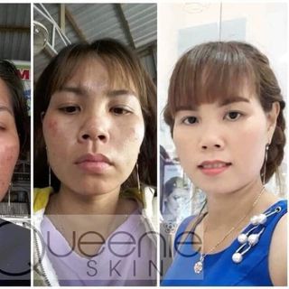FACE TRỊ NÁM - TÀN NHANG QUEENIE SKIN