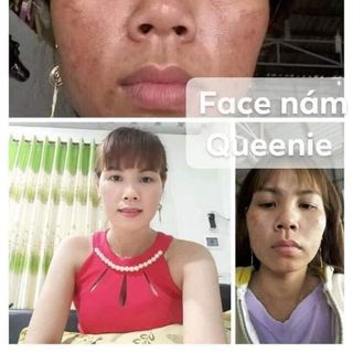 FACE TRỊ NÁM - TÀN NHANG QUEENIE SKIN