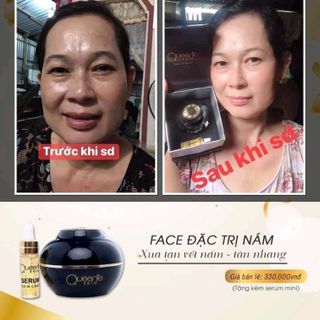 kem trị nám
