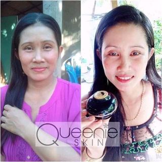 kem trị nám Queenie