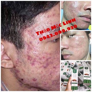 Trị mụn-rỗ-nám-tàn nhang Thảo Mộc Linh