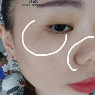 GIÁ SỈ HUYẾT HỒNG SÂM TRỊ MỤN