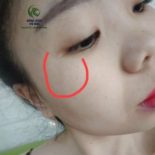 GIÁ SỈ HUYẾT HỒNG SÂM TRỊ MỤN