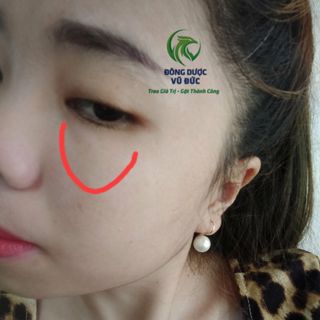 GIÁ SỈ HUYẾT HỒNG SÂM TRỊ MỤN