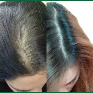 Tính dầu đông y đặc trị rụng tóc trị hói tóc mọc tua tủa