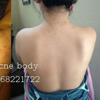 Trị mụn lưng