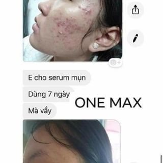 Serum trị mụn ONEMAX
