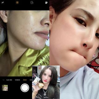 Serum trị mụn ONEMAX
