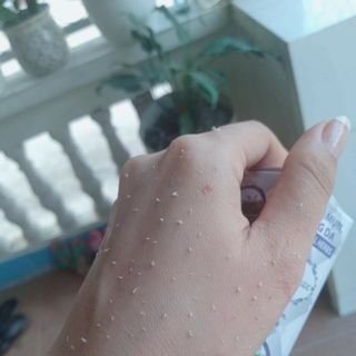 Serum trị mụn ONEMAX