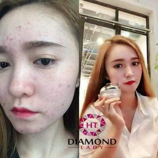 KEM FACE MỤN LITION DIAMOND LADY