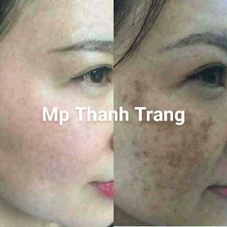 Đông Y Trị Mụn Cấp Tốc Thanh Trang
