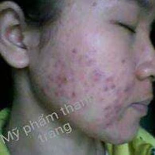 Đông Y Trị Mụn - Sẹo Rỗ Thanh Trang