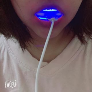 Máy làm trắng răng tại nhà