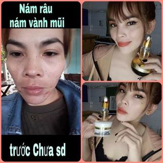Kem trị nám onemax