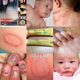 Thuần Mộc khắc tinh bệnh Da Liễu